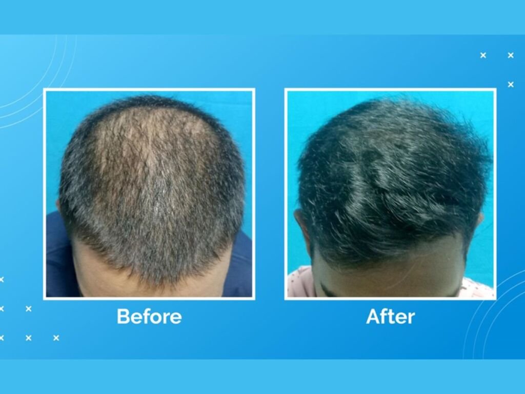 Vcare’s Treatment For Hair Loss And Hair Thinning