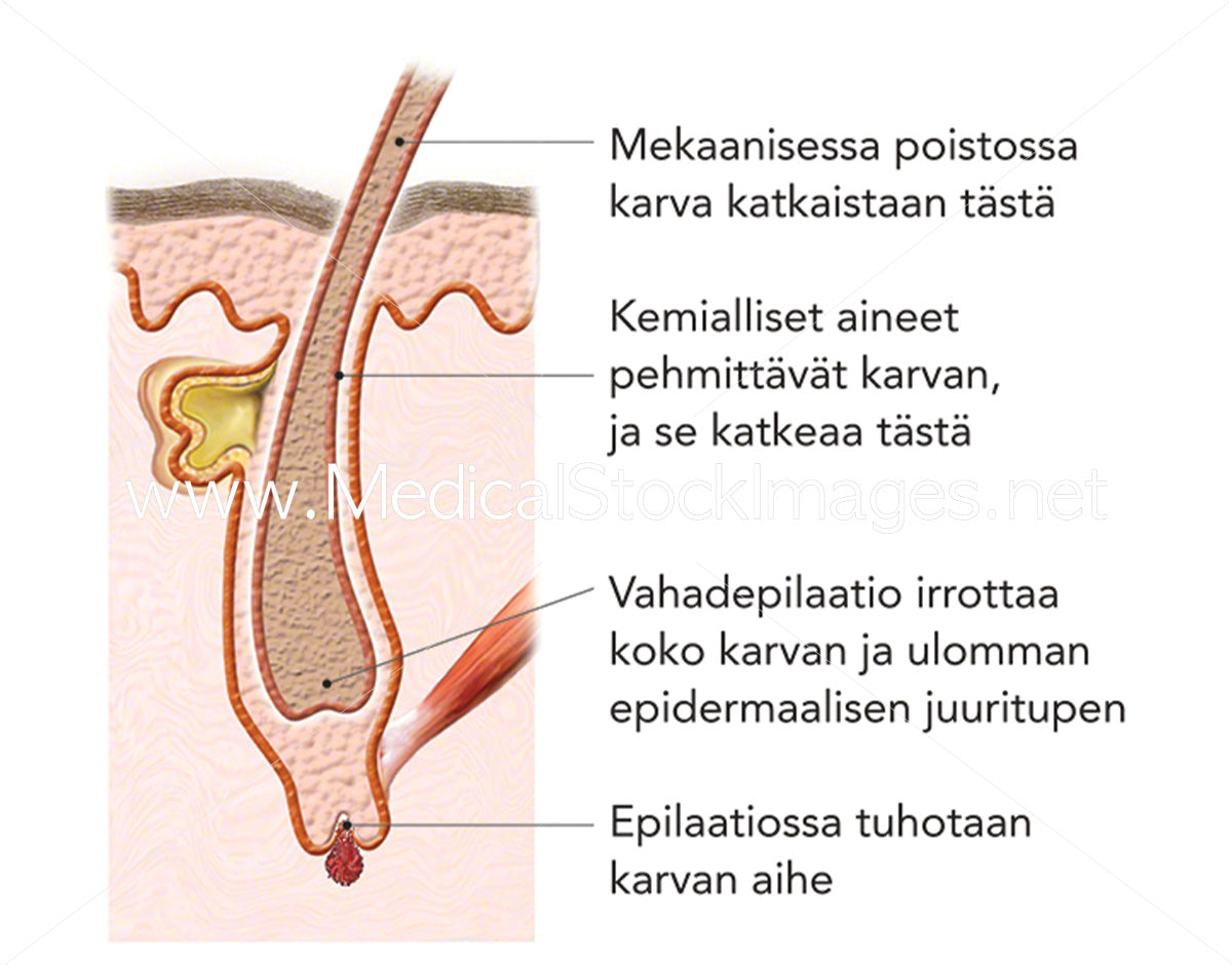 Laser Hair Removal