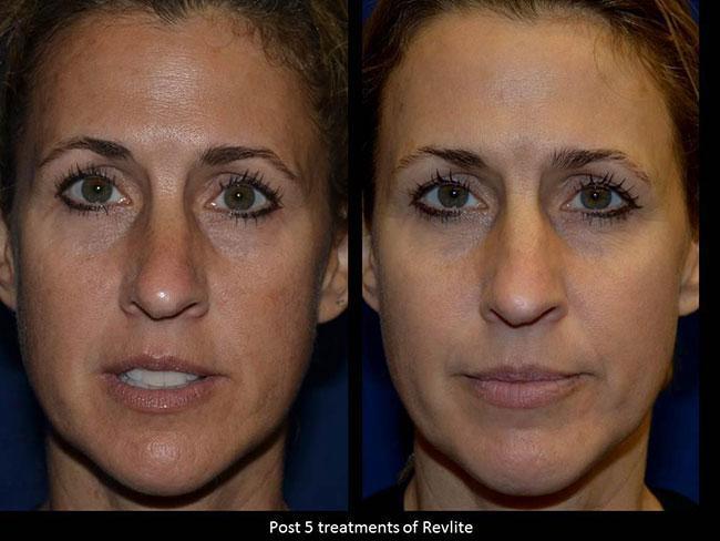 Laser Skin Treatments