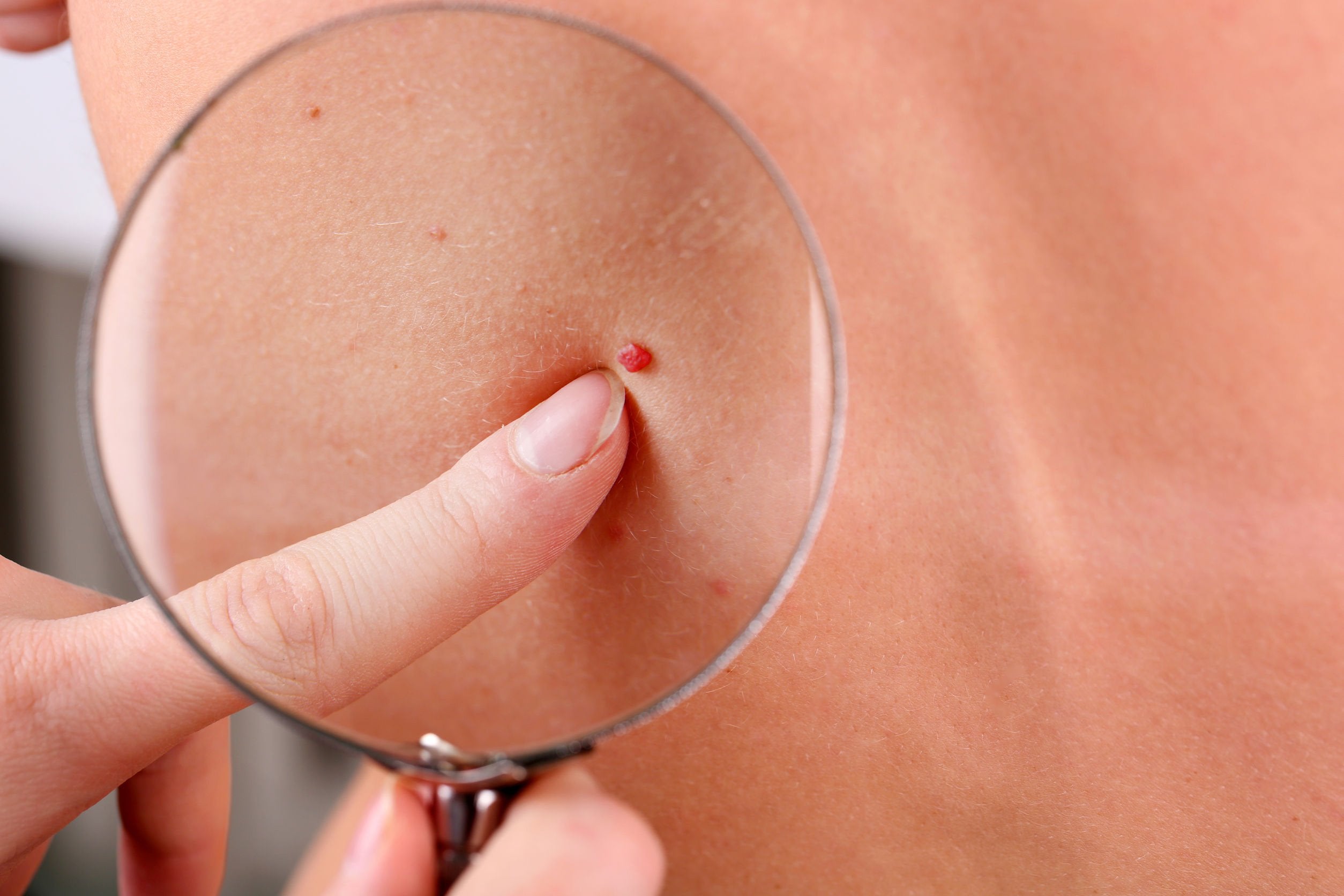 Cherry Angioma: Should You Be Concerned About These Red Moles?