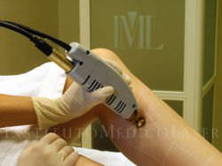 Laser Hair Removal procedure