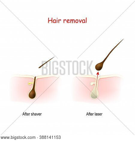 Hair Removal