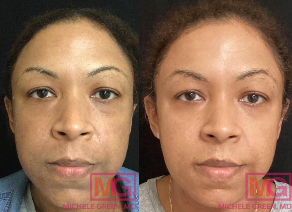 Microneedling Raleigh Nc Can Be Fun For Anyone