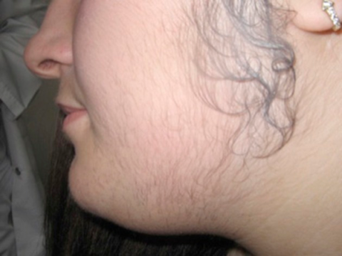 Hirsutism depicted in a female patient with PCOS and nonclassic congenital adrenal hyperplasia