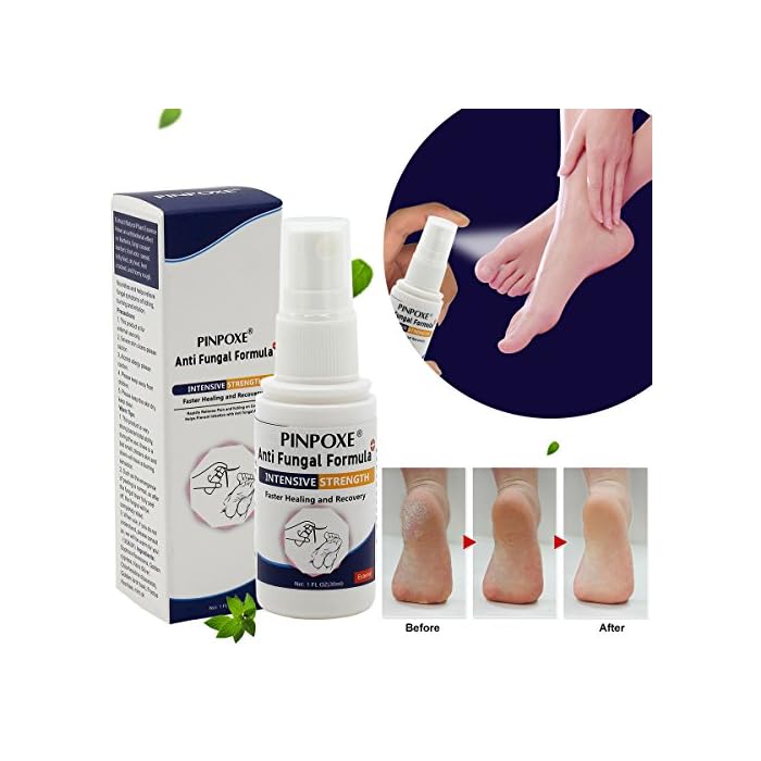 Athletes Foot Spray, Jock Itch Foot Spray, Foot Sanitiser, Athletes Foot Treatment, Antibacterial Deodorant, Anti Itch Anti-fungi Athletes Foot Liquid, Prevents Reinfection Soothe Itching, 30ml