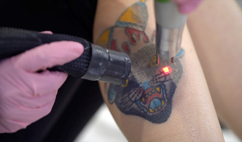 Laser away faq image for What Skin Tones Experience The Best Results For Tattoo Removal?