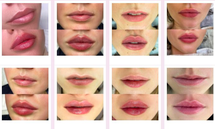 lip filler before and after pictures 1