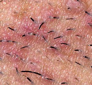 Dealing with ingrown hair: Laser hair removal and other options