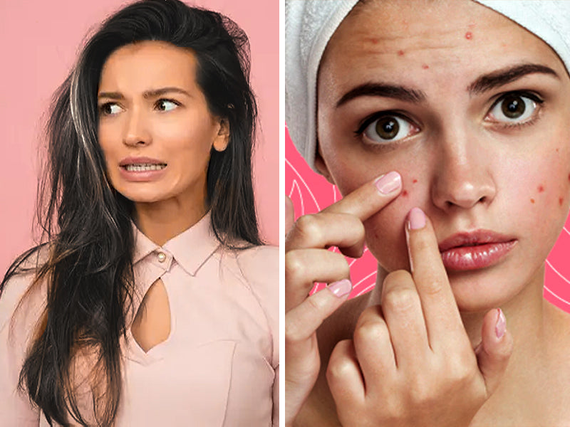 20 Ways To Treat PCOS-Related Skin & Hair Problems