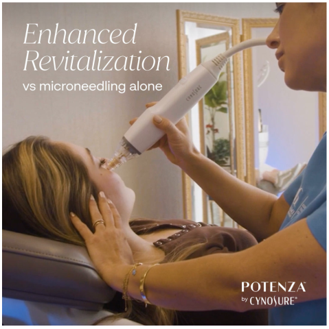 Laser Skin Clinic introduces Potenza RF Microneedling for enhanced Skin Tightening, Acne Scars, and Stretch Marks