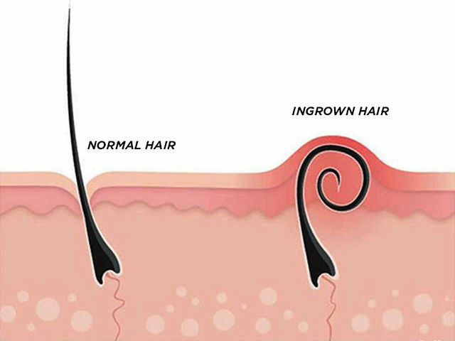 Laser Hair Removal