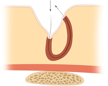 Fig. 13.2 Pathogenesis of lose hair inserting and burrowing under the skin, forming a sinus tract