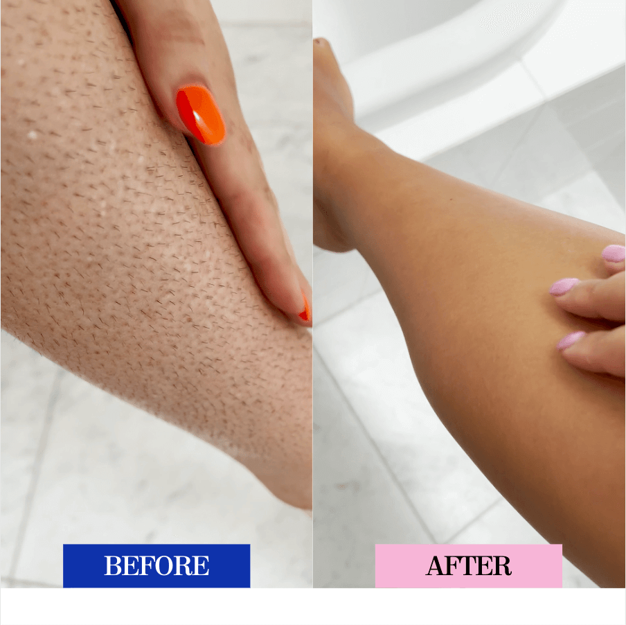 Laser Hair Removal Atlanta