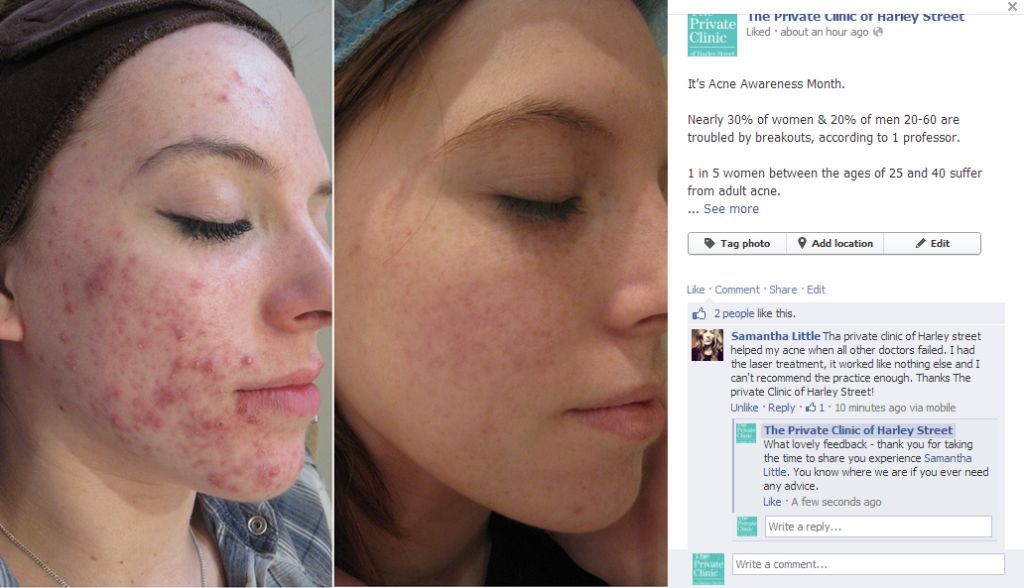 N-Lite Laser Acne Treatment Before and After