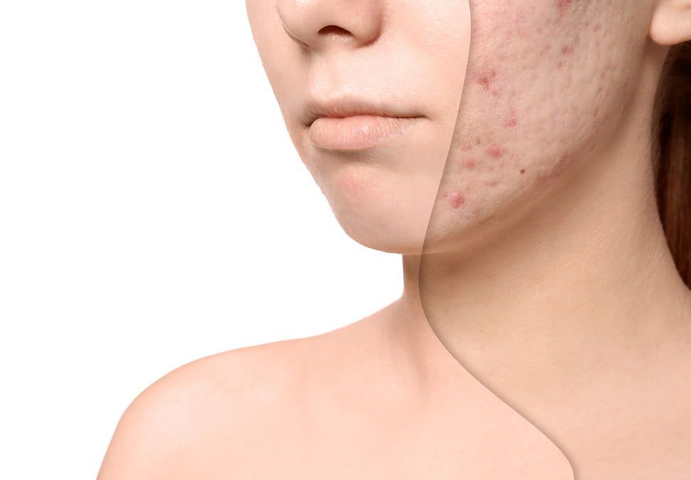 Skin Specialists Talk About Famous Acne Scar Treatments