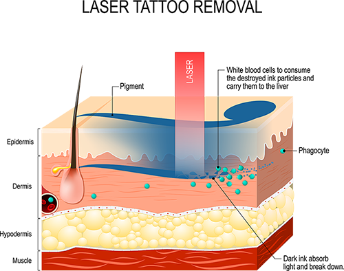 How Tattoo Removal Works