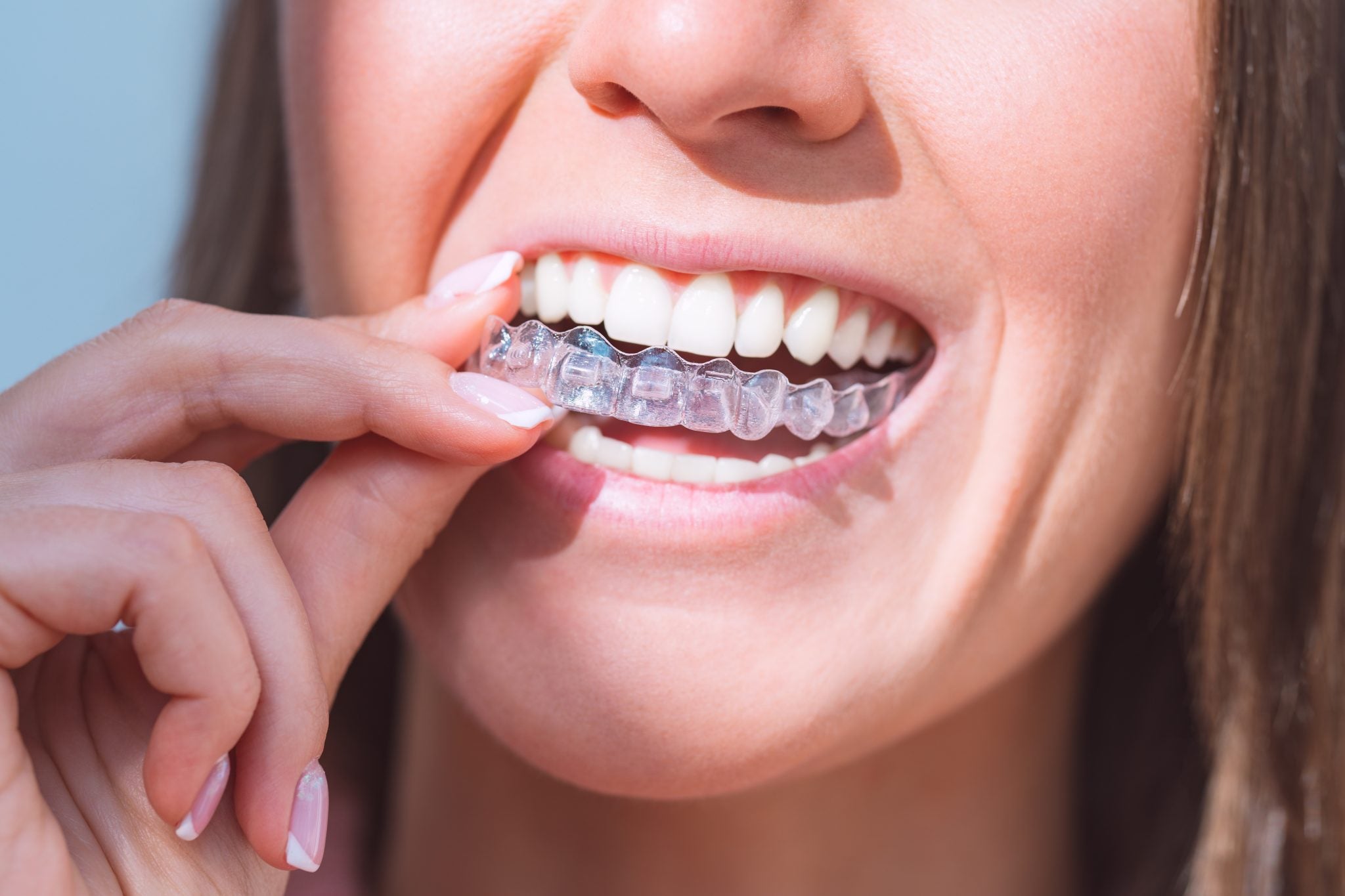 Clear aligners - smilelign - at DrBK Reading