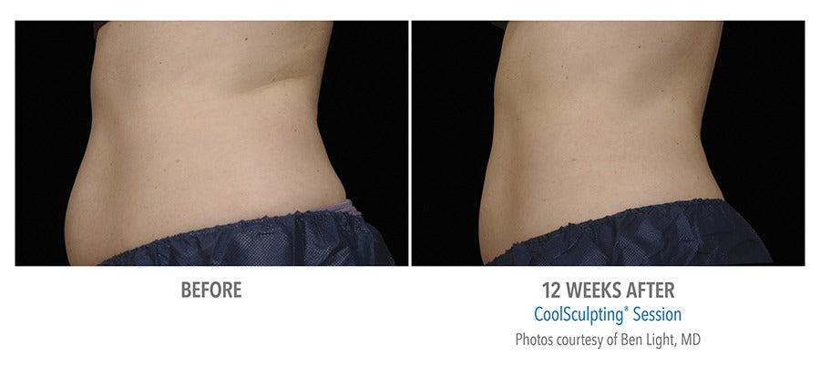 Tag Archives: coolsculpting