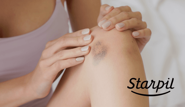 Preventing and Treating Bruising When Waxing