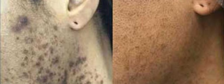 Before and After Facial Laser Hair Removal Treatments