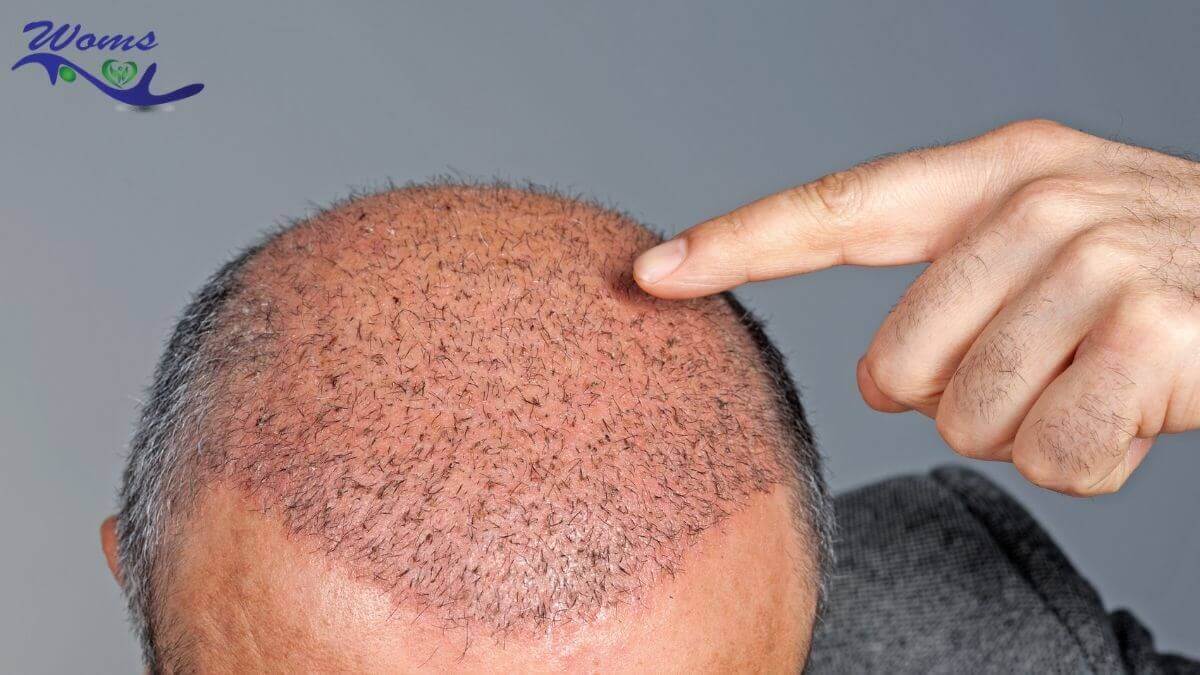 Best hair transplant