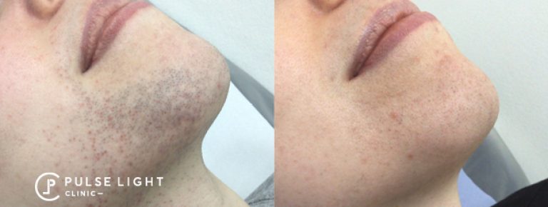 Before and after laser hair removal chin