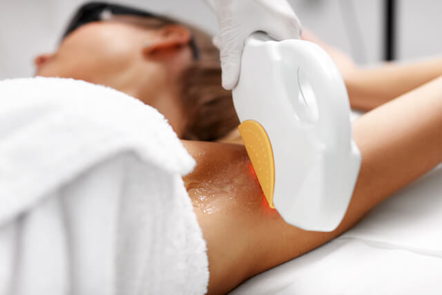 Laser Hair Removal