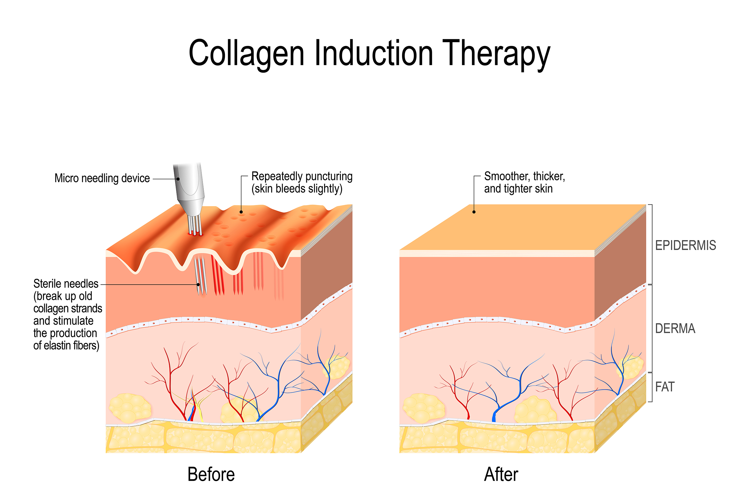 The Facts About Certified Laser Hair Removal Specialists Uncovered