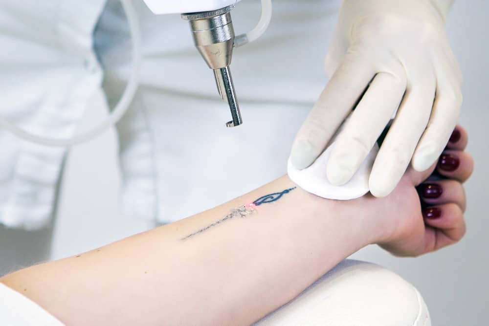 5 things you should know about tattoo removal