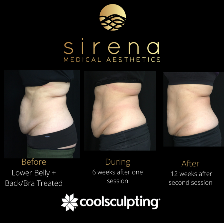 coolsculpting near me