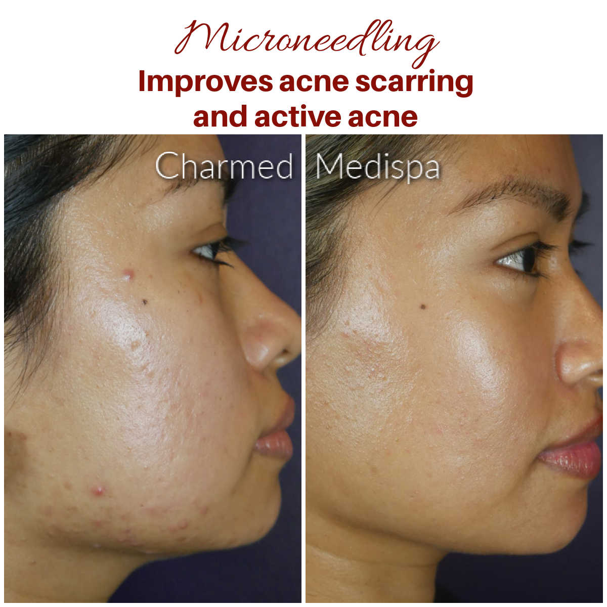 Microneedling Raleigh NC