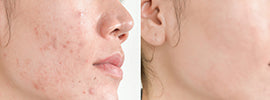 What are the side effects of dermaplaning? The experts from Boston’s best medical spa answer your question