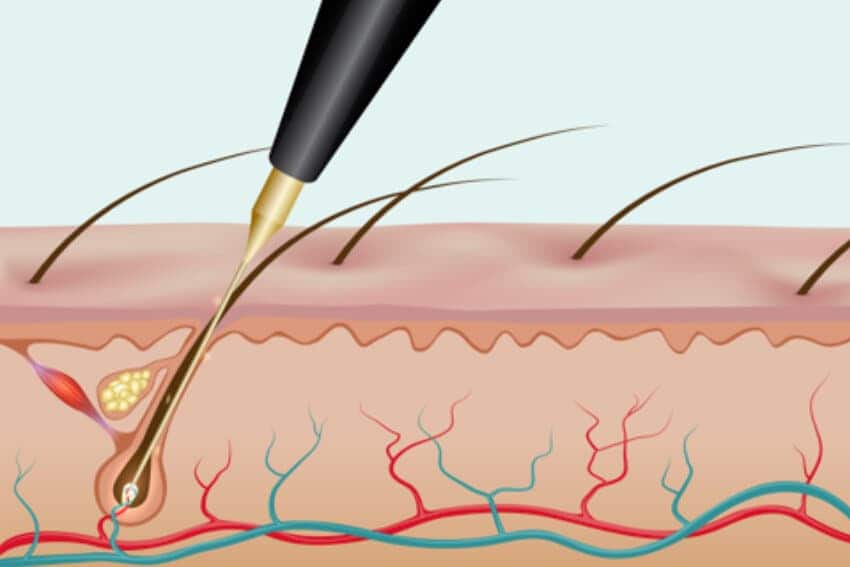 Electrolysis vs Laser Hair Removal