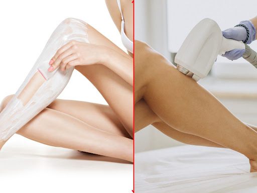 Hair Removal Method