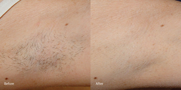 Your Best South Bay Laser Hair Removal Provider