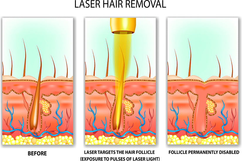 How Laser Hair Removal Works