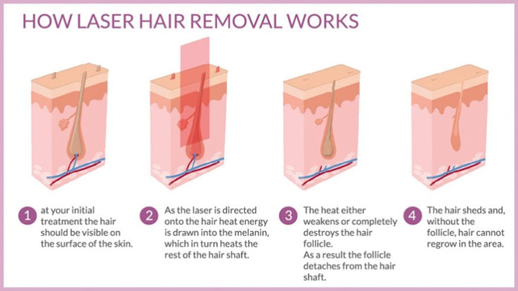 How Safe Is Laser Hair Removal & How It Works?