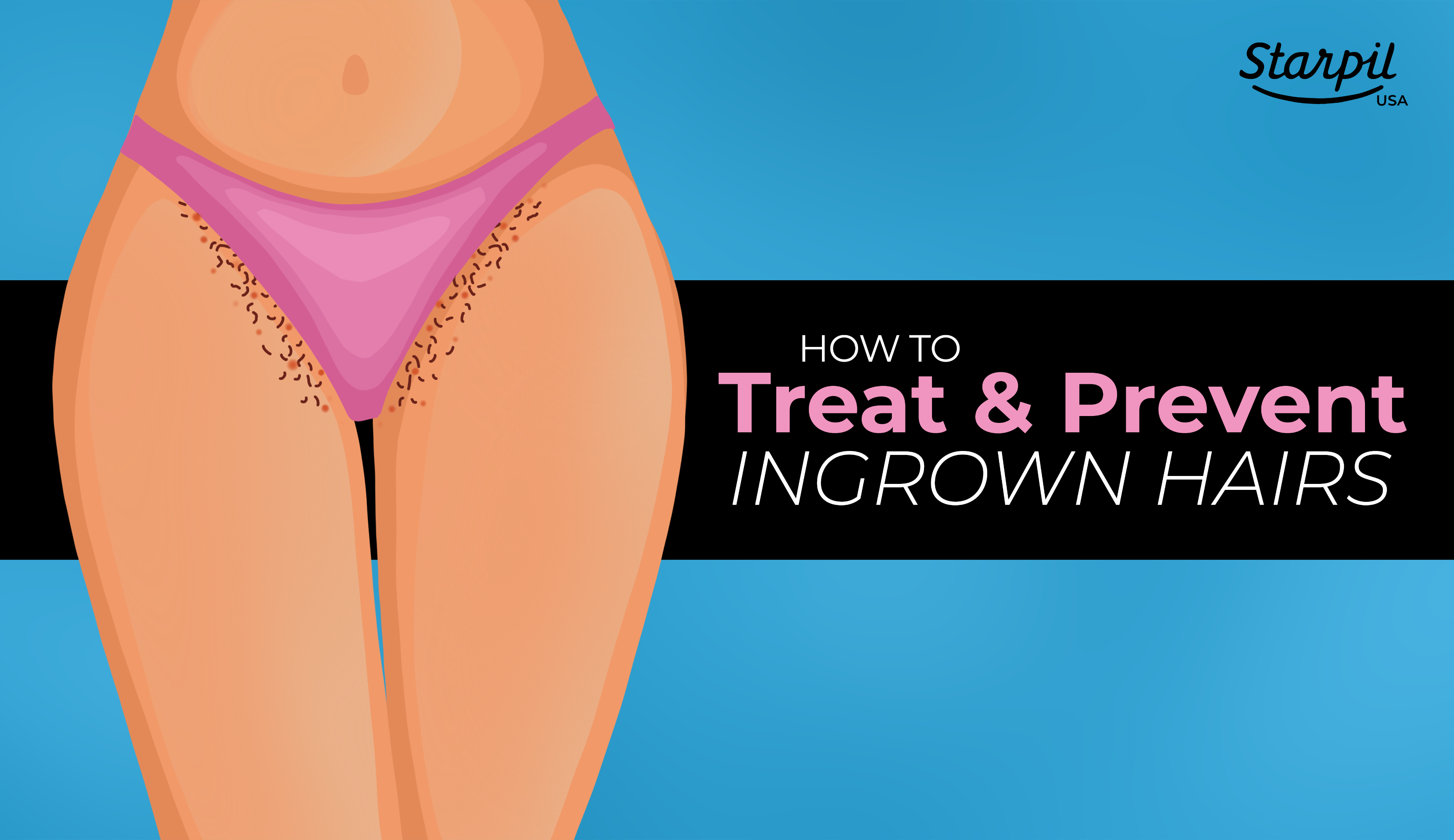 How to Treat and Prevent Ingrown Hairs After Waxing