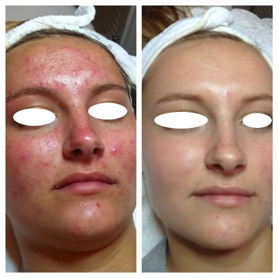 Skinbody Nashville Chemical Peel