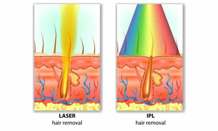 IPL Home Devices vs Laser Hair Removal