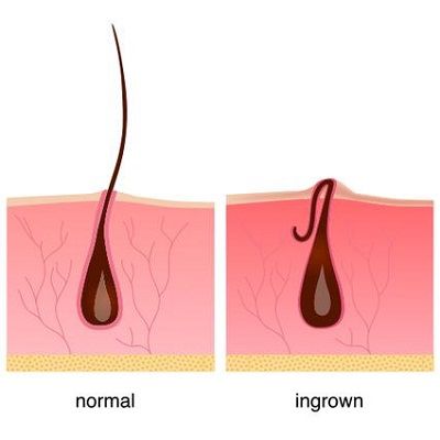 Ingrown Hair - Symptoms, Causes, and Treatment | Laser Hair Removal in Dubai