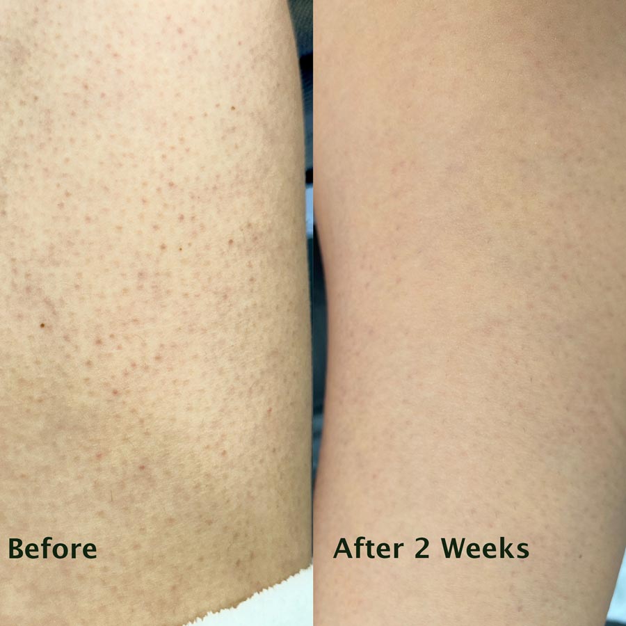 Keratosis Pilaris Treatment: How I Got Rid of My Keratosis Pilaris (Chicken Skin) 1