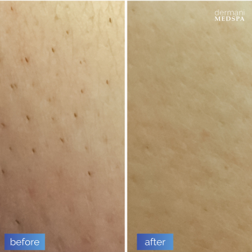 Why come to dermani MEDSPA® in Dallas, TX (Preston Hollow) for Laser Hair Removal?