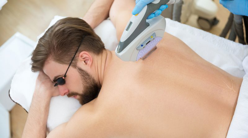 Laser Hair Removal