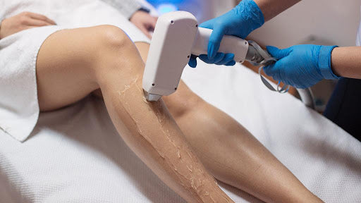 Laser Hair Removal In Delhi