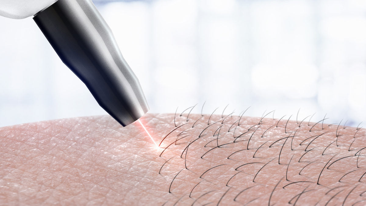 cosmetology procedure laser hair removal on body parts. Laser epilation.