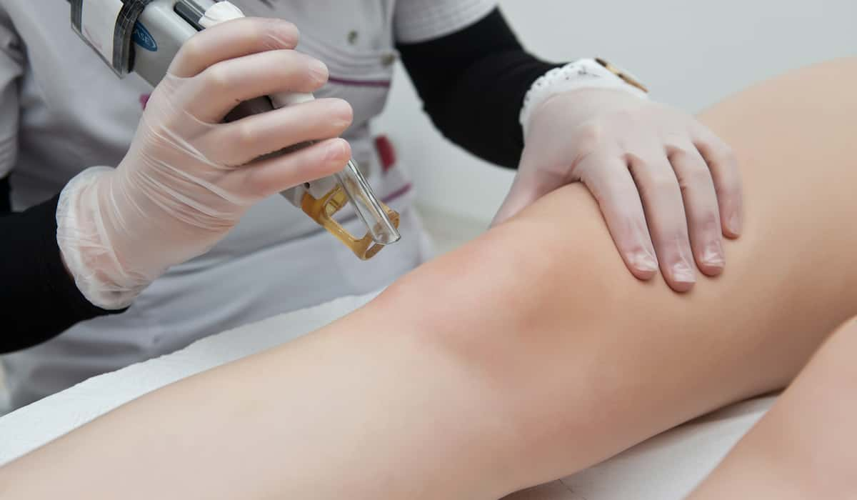 Laser Hair Removal