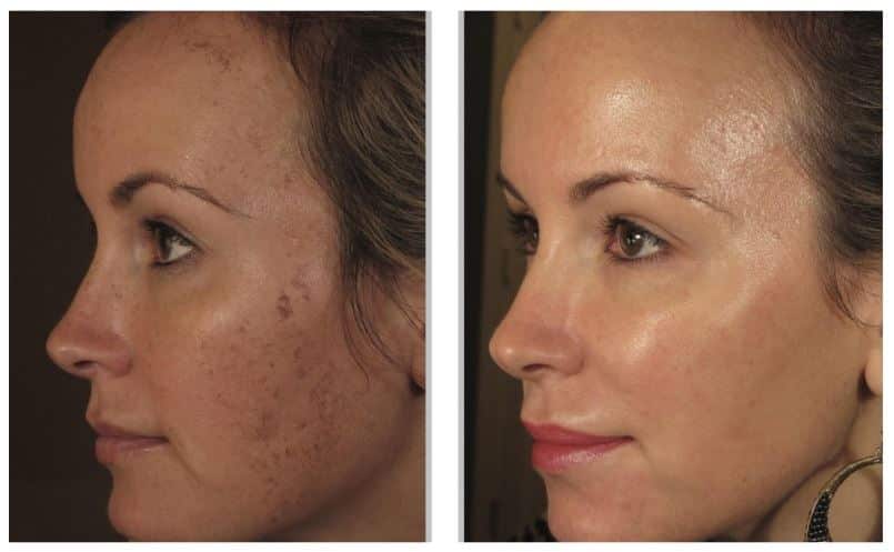 Laser Skin Treatments