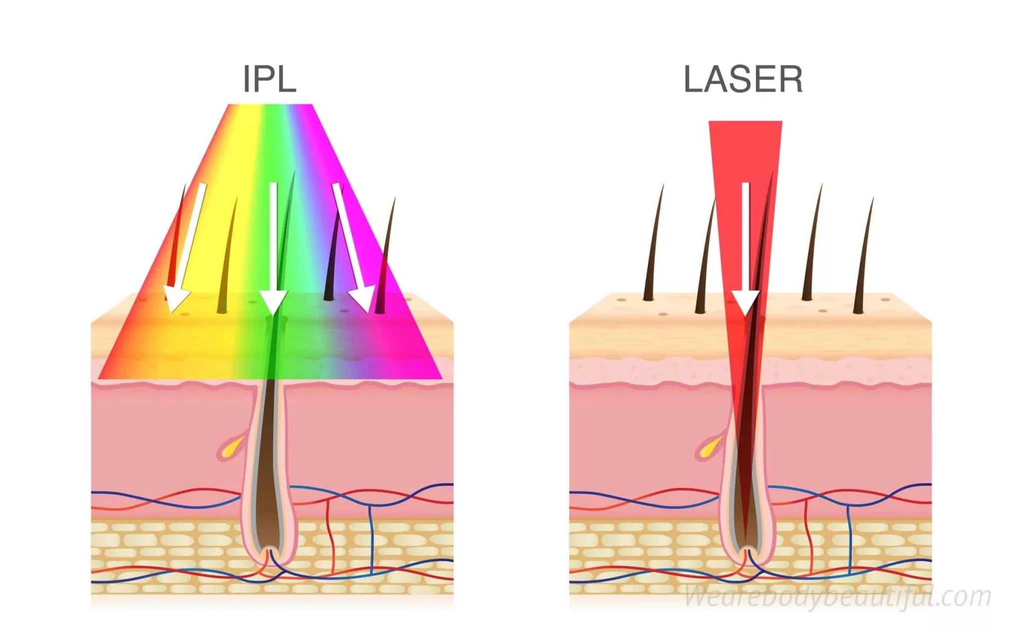 IPL is multi-wavelength whereas laser is just one wavelength (monochromatic). Laser & IPL energy with wavelengths from 600 to 1100nm is absorbed by the dark melanin pigment in your hair follicle.