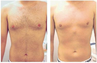 Men laser hair removal chest